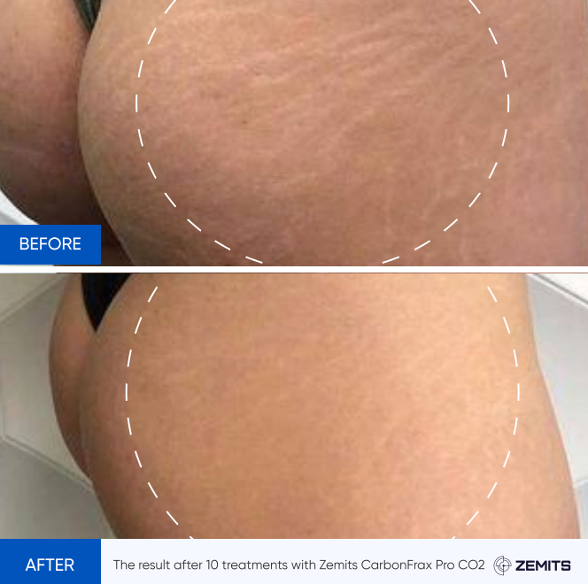 Zemits CarbonFrax Pro: CO2 Fraktionierter Laser