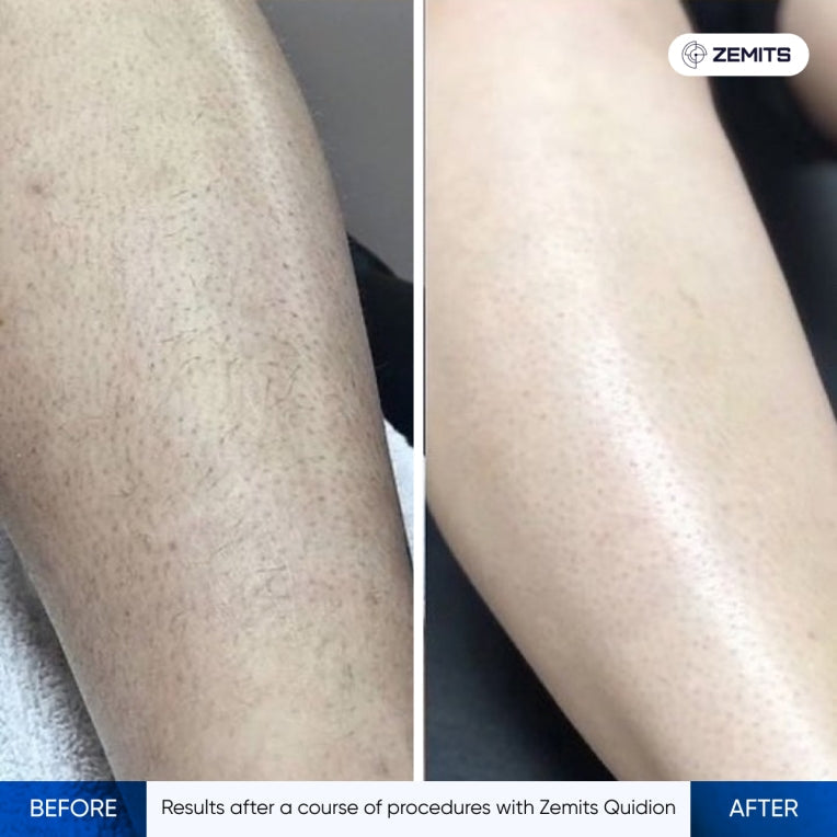 Zemits Quidion Diodenlaser zur Haarentfernung