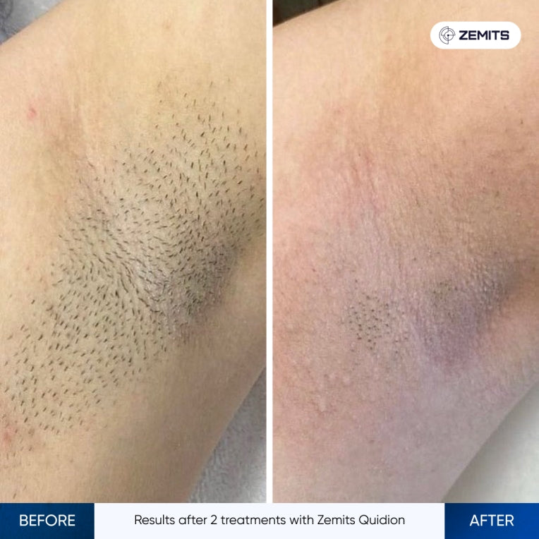 Zemits Quidion Diodenlaser zur Haarentfernung