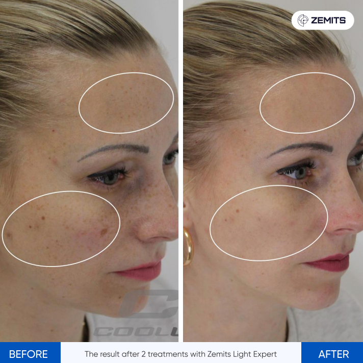 Zemits Light Expert 2.0 IPL Lasergerät