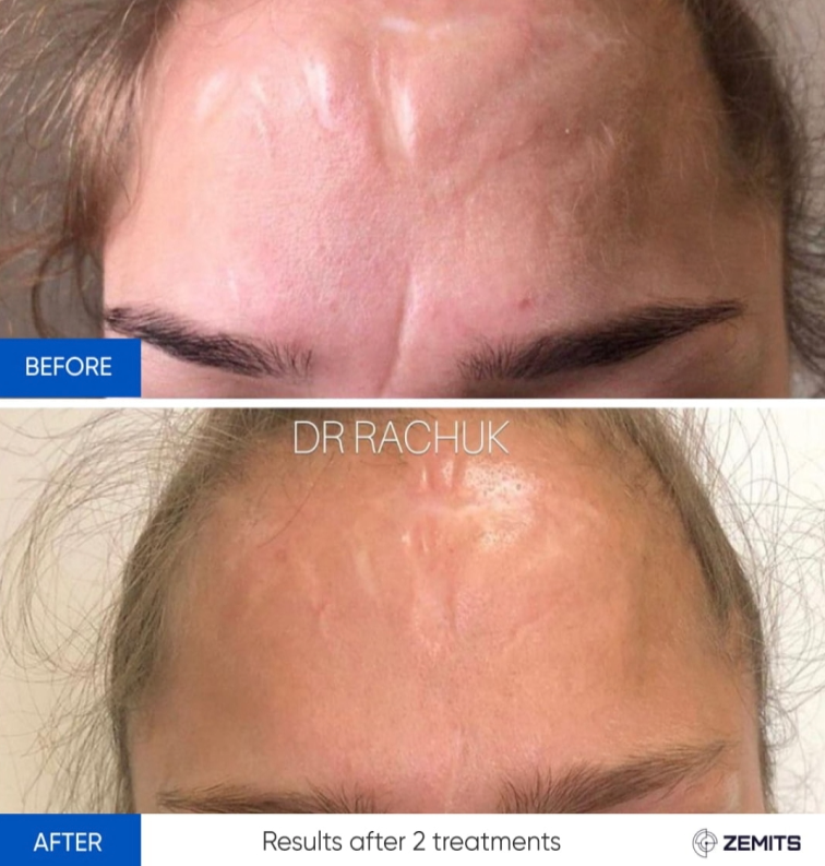 Zemits CarbonFrax Pro: CO2 Fraktionierter Laser