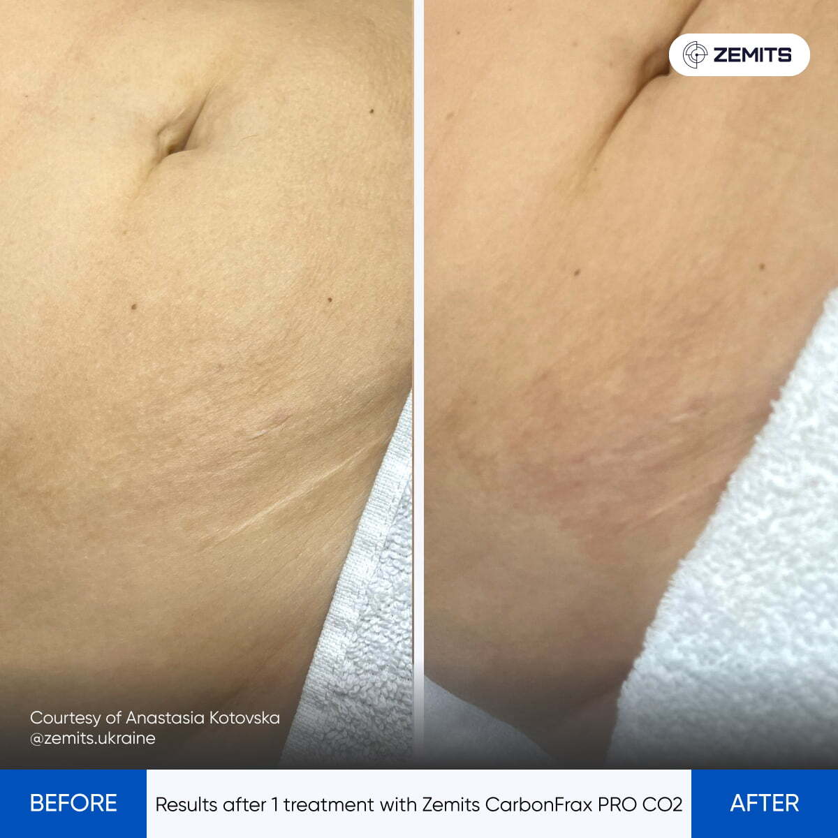 Before After Slide 4