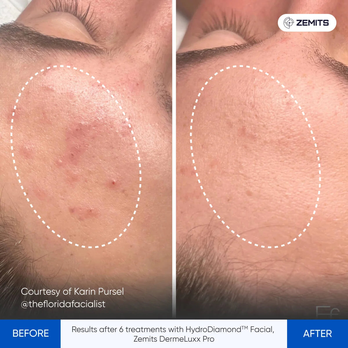 Before and after hydrodermabrasion results Zemits DermeLuxx Pro