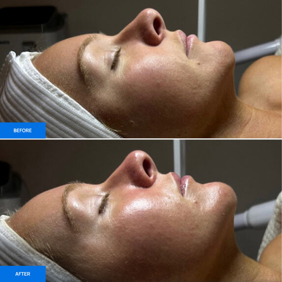 Before After Slide 4