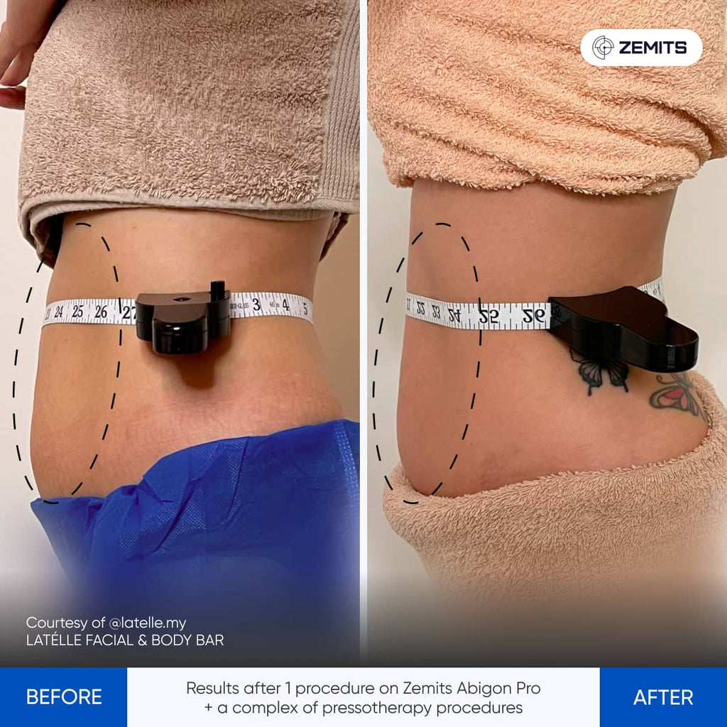 Before and after comparison of a person's waist using Zemits Abigon Pro device.