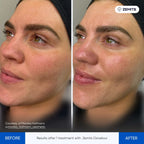 Before and after oxygen facial results Zemits OxiVelour