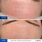 Before and after radiofrequency results Zemits Klein RF 2.0