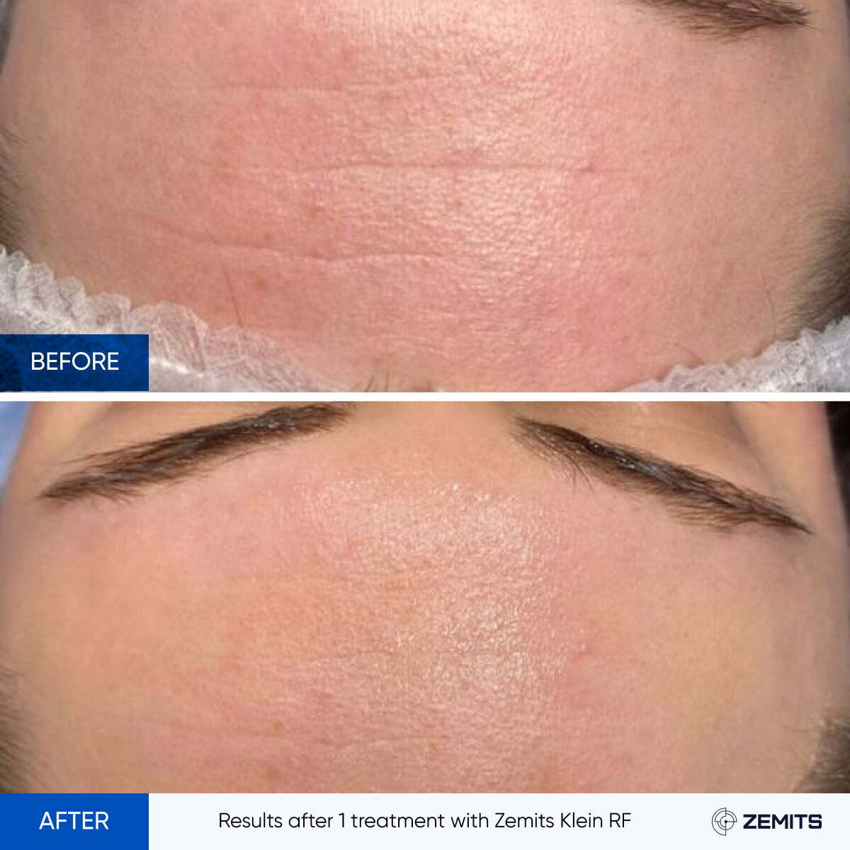 Before and after radiofrequency results Zemits Klein RF 2.0