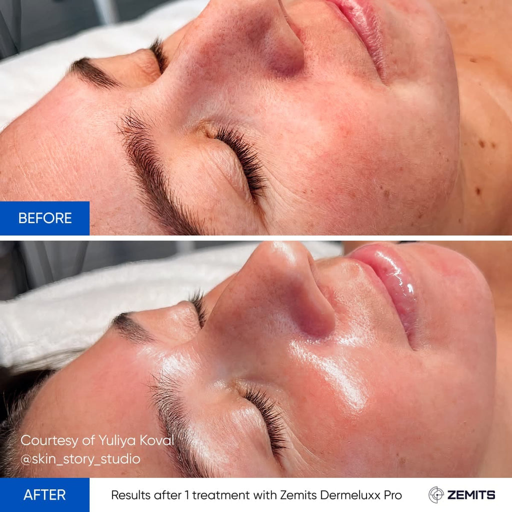 Before and after hydrodermabrasion results Zemits DermeLuxx Pro