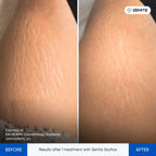 Before and after RF microneedling results Zemits SkyFrax Pro