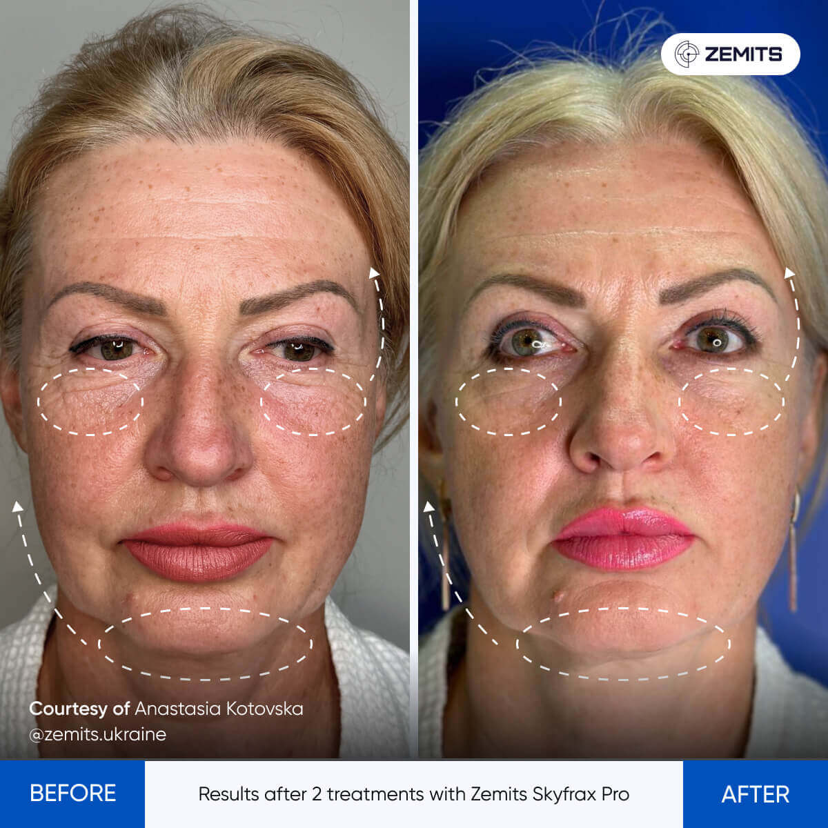 Before After Slide 1