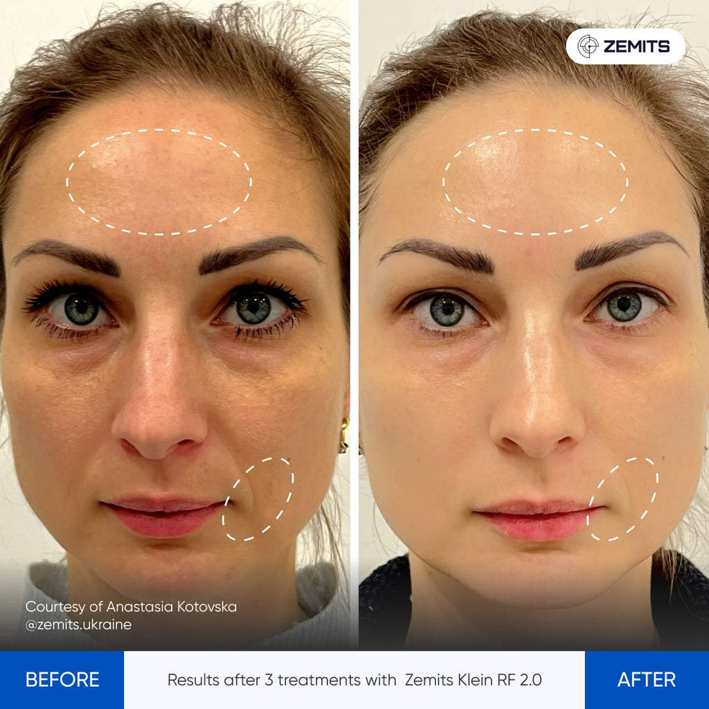 Before and after radiofrequency results Zemits Klein RF 2.0