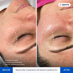 Before and after fractional RF results CrystalFrax Pro MD