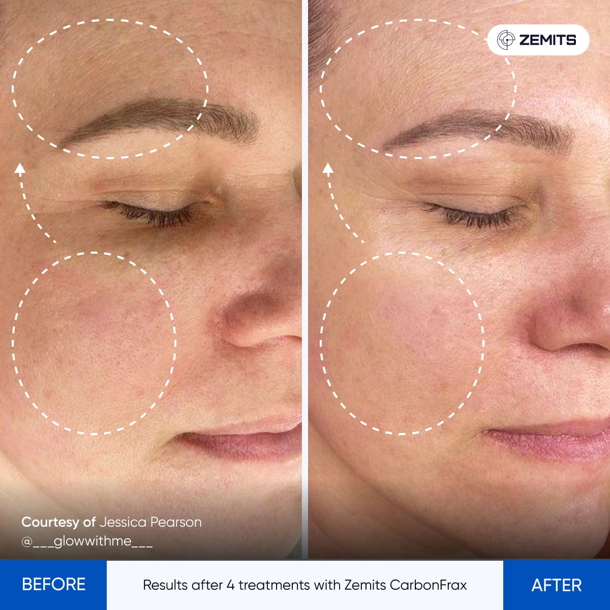 Before After Slide 4