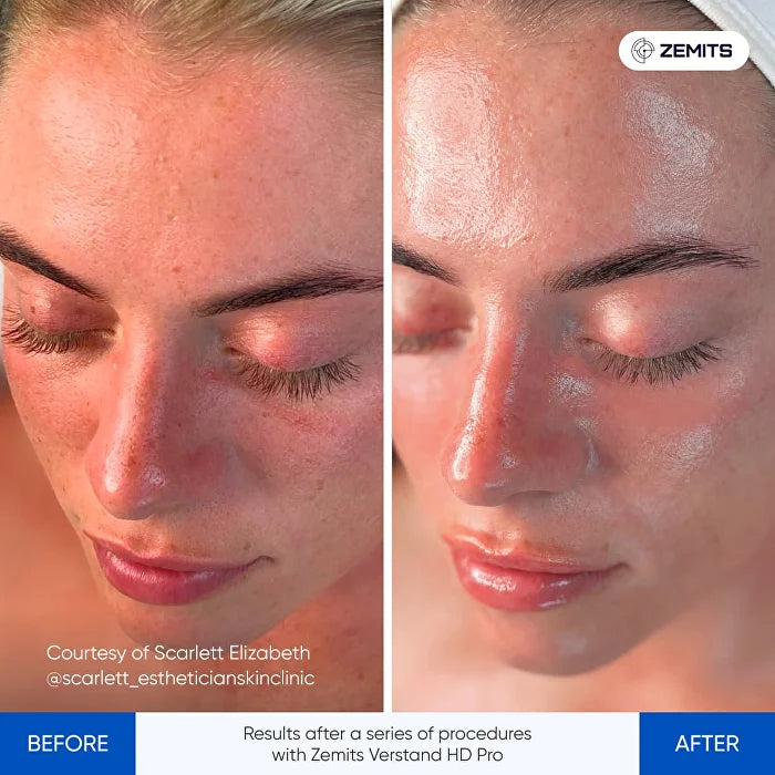 Before After Slide 1