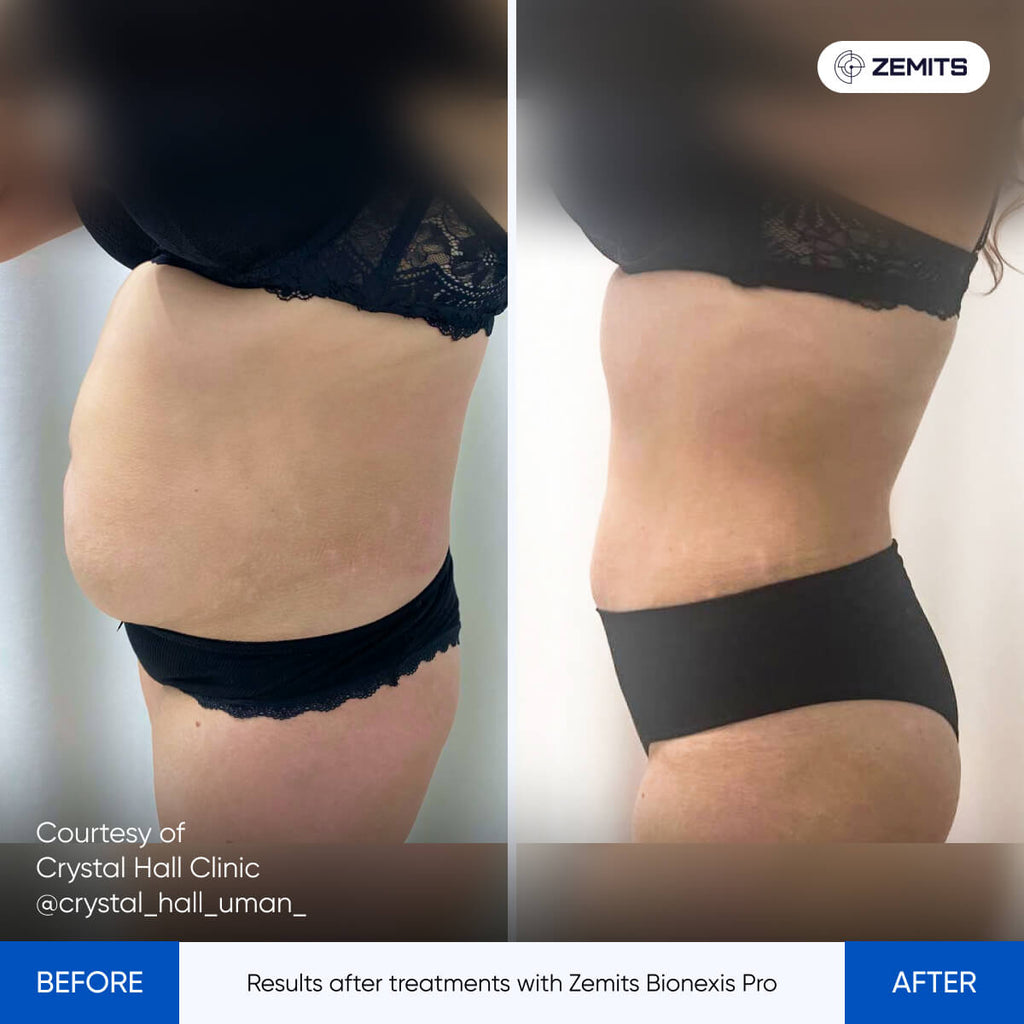 Before and after body contouring results Zemits Bionexis Pro