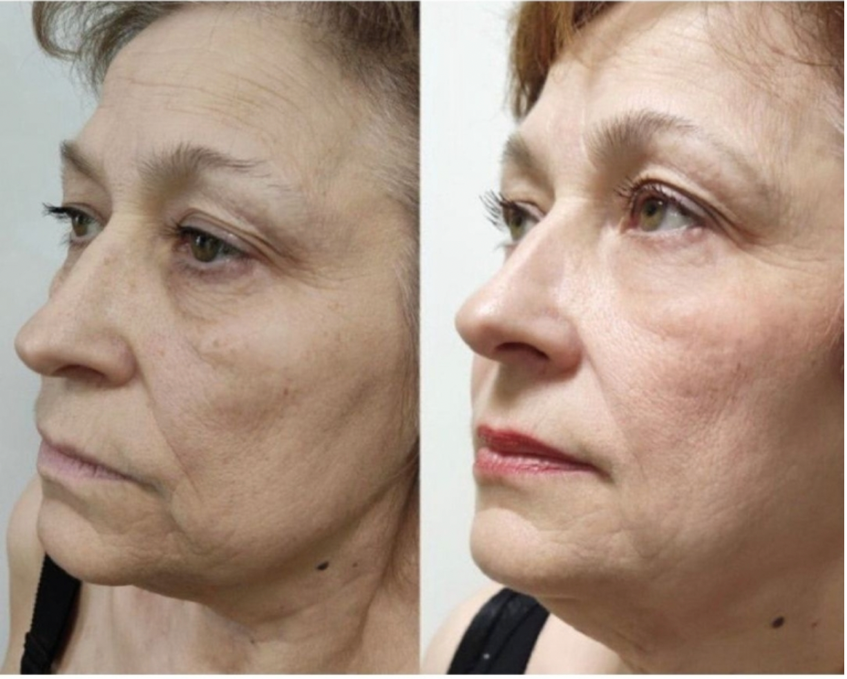 Zemits LumaGenix PDT Professionelles LED-Lichttherapiegerät