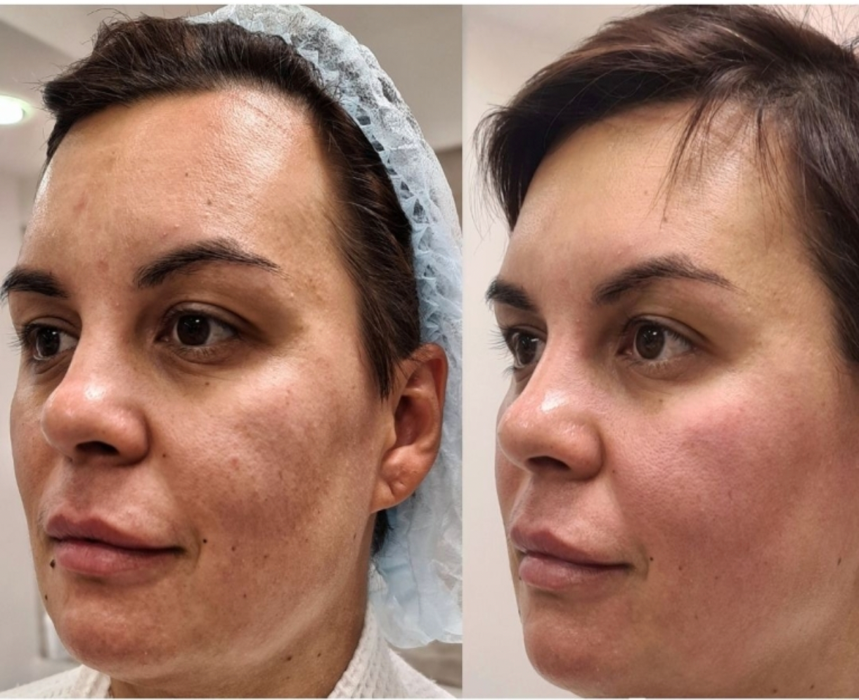 Zemits LumaGenix PDT Professionelles LED-Lichttherapiegerät
