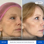 Before and after HIFU facelift results Zemits UltraNexx Lite
