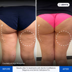 Before and after cellulite reduction results Zemits CelluSpice Pro