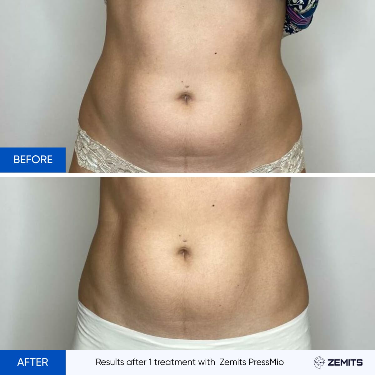 Before and after pressotherapy results Zemits PressMio