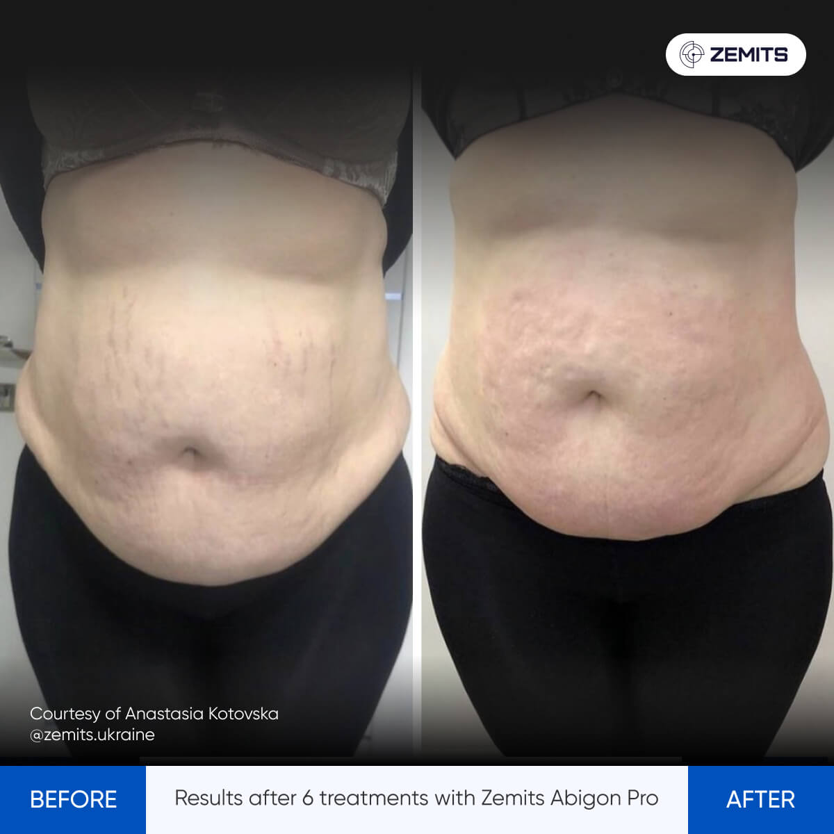 Before and after results of Zemits Abigon Pro treatment on a person's abdomen.