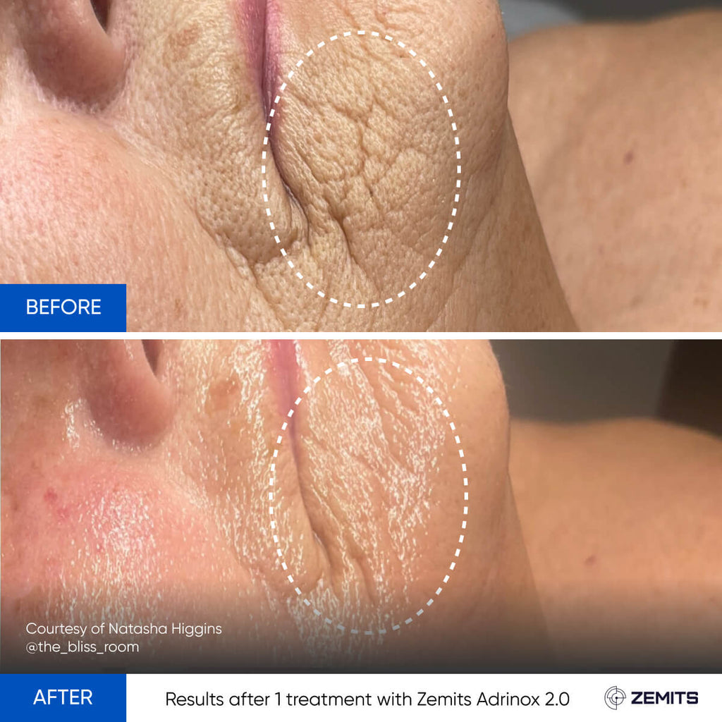 Before and after microcurrent therapy results Zemits Adrinox 2.0