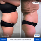 Before and after body sculpting results Zemits Bionexis Lite