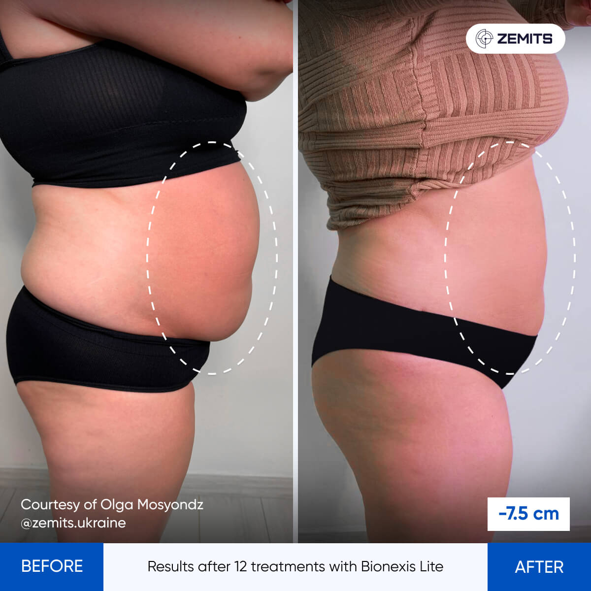 Before and after body sculpting results Zemits Bionexis Lite