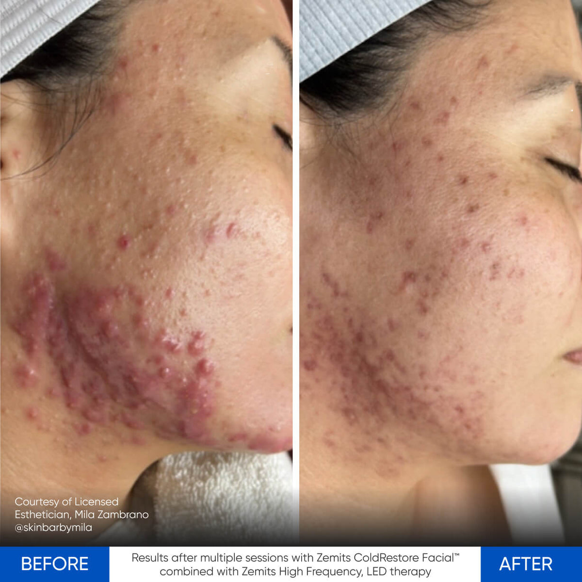 Before After Slide 4