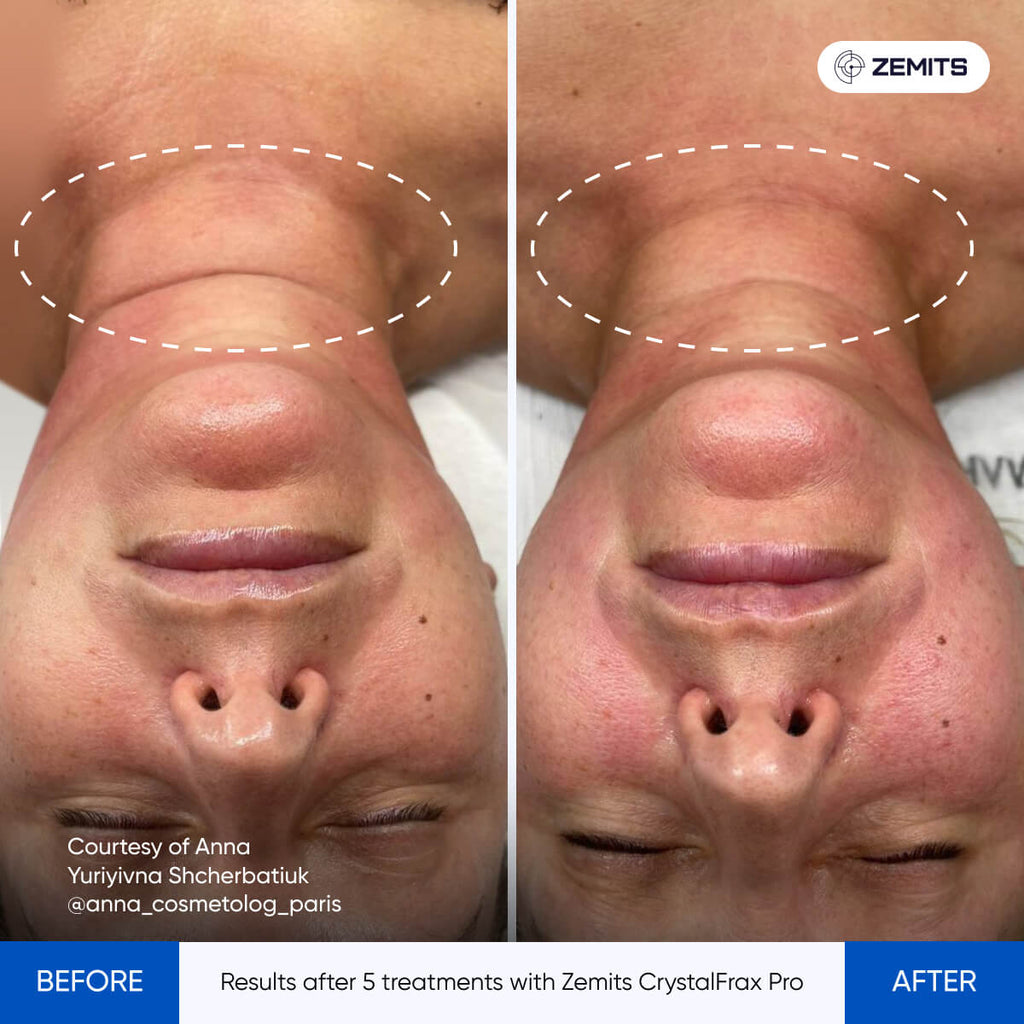 Before and after fractional RF treatment results CrystalFrax Pro