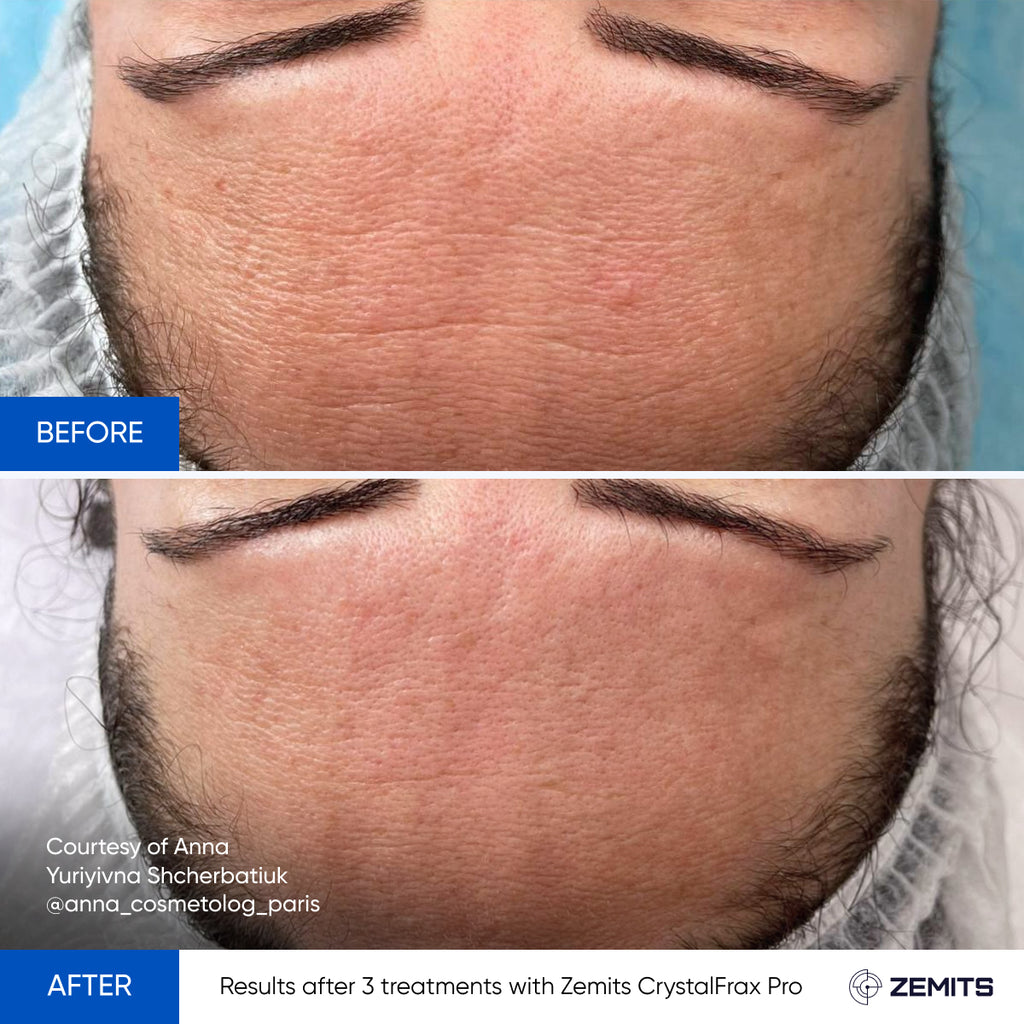 Before and after cellulite reduction results Zemits CelluSpice Pro