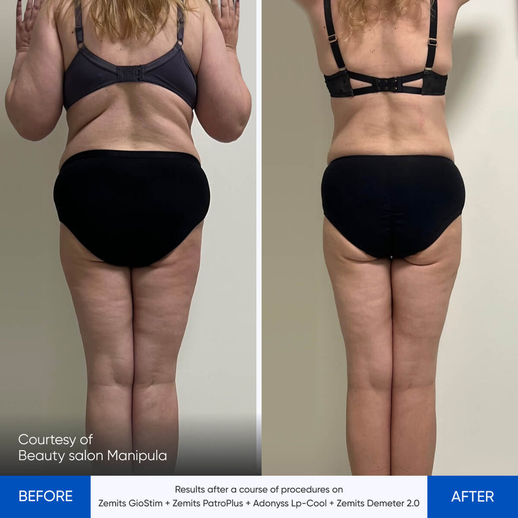 Before and after pressotherapy results Zemits Demeter 2.0