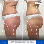 Before and after pressotherapy results Zemits Demeter 2.0
