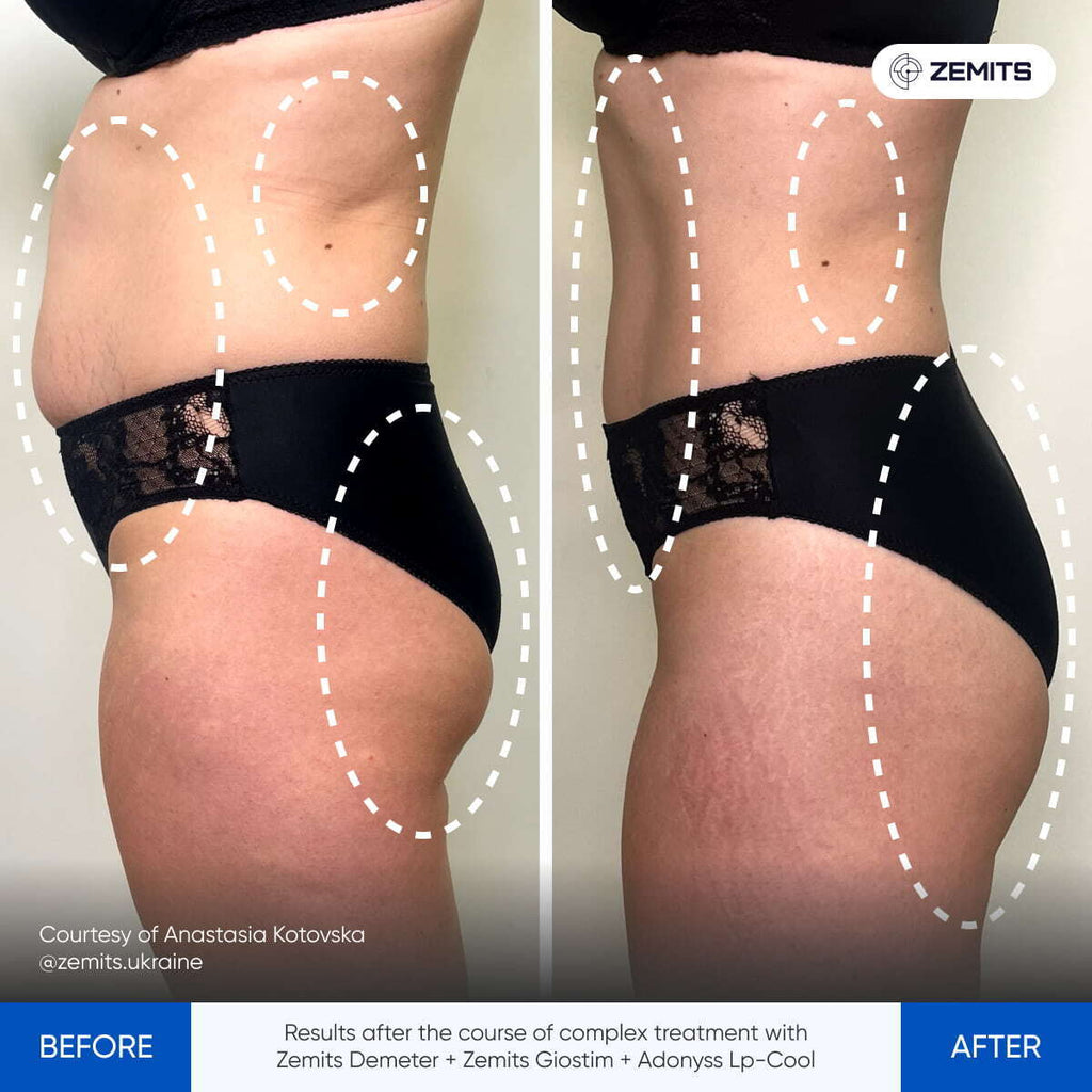 Before and after pressotherapy results Zemits Demeter 2.0