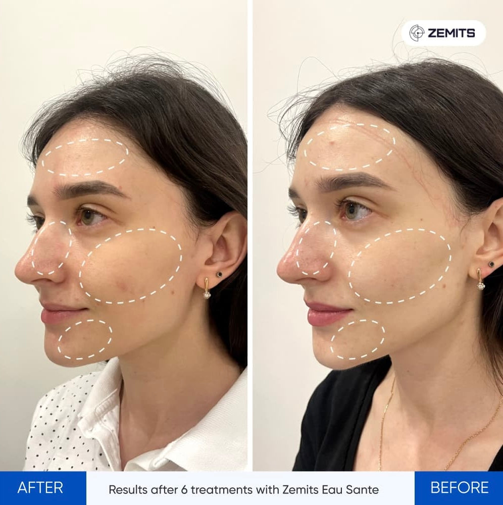 Before and after hydrodermabrasion results Zemits Eau Sante