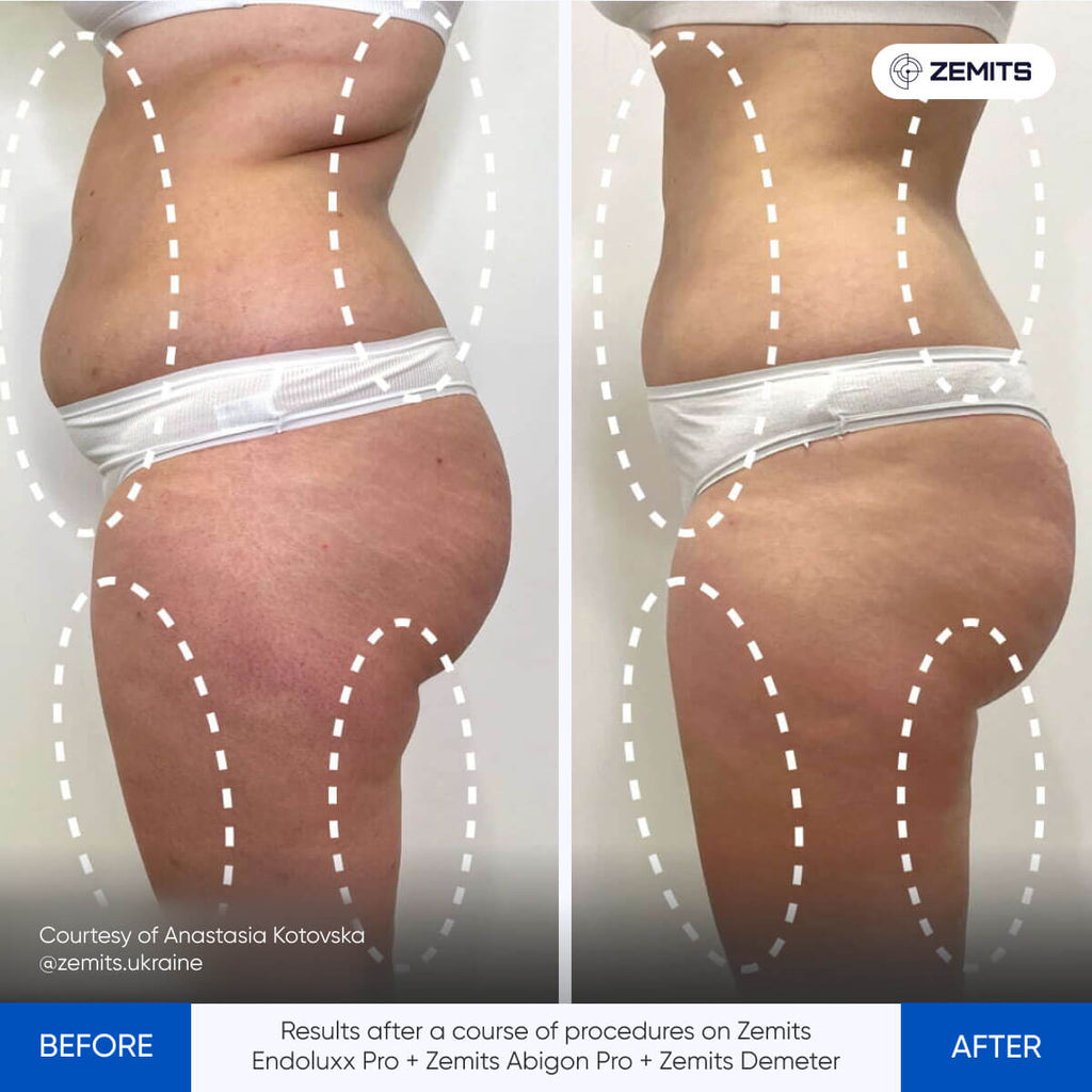 Before and after contouring results Zemits EndoLuxx Pro