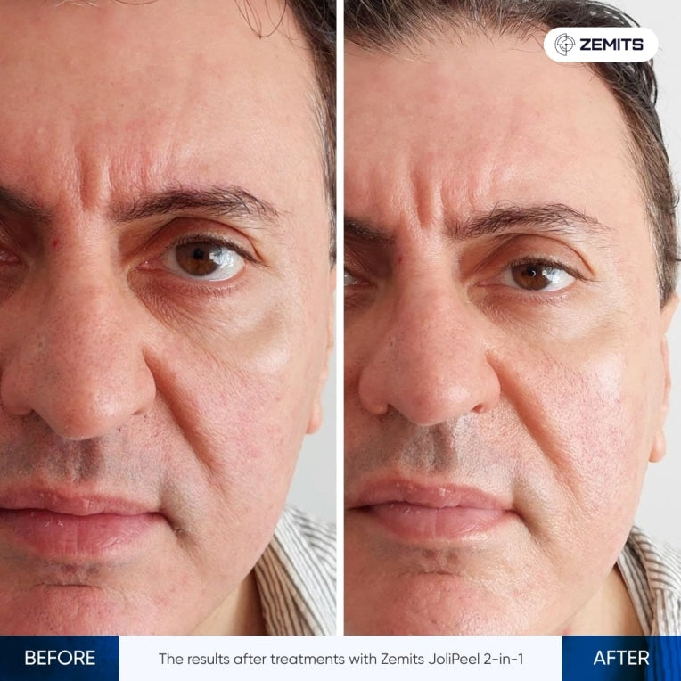 Before After Slide 2