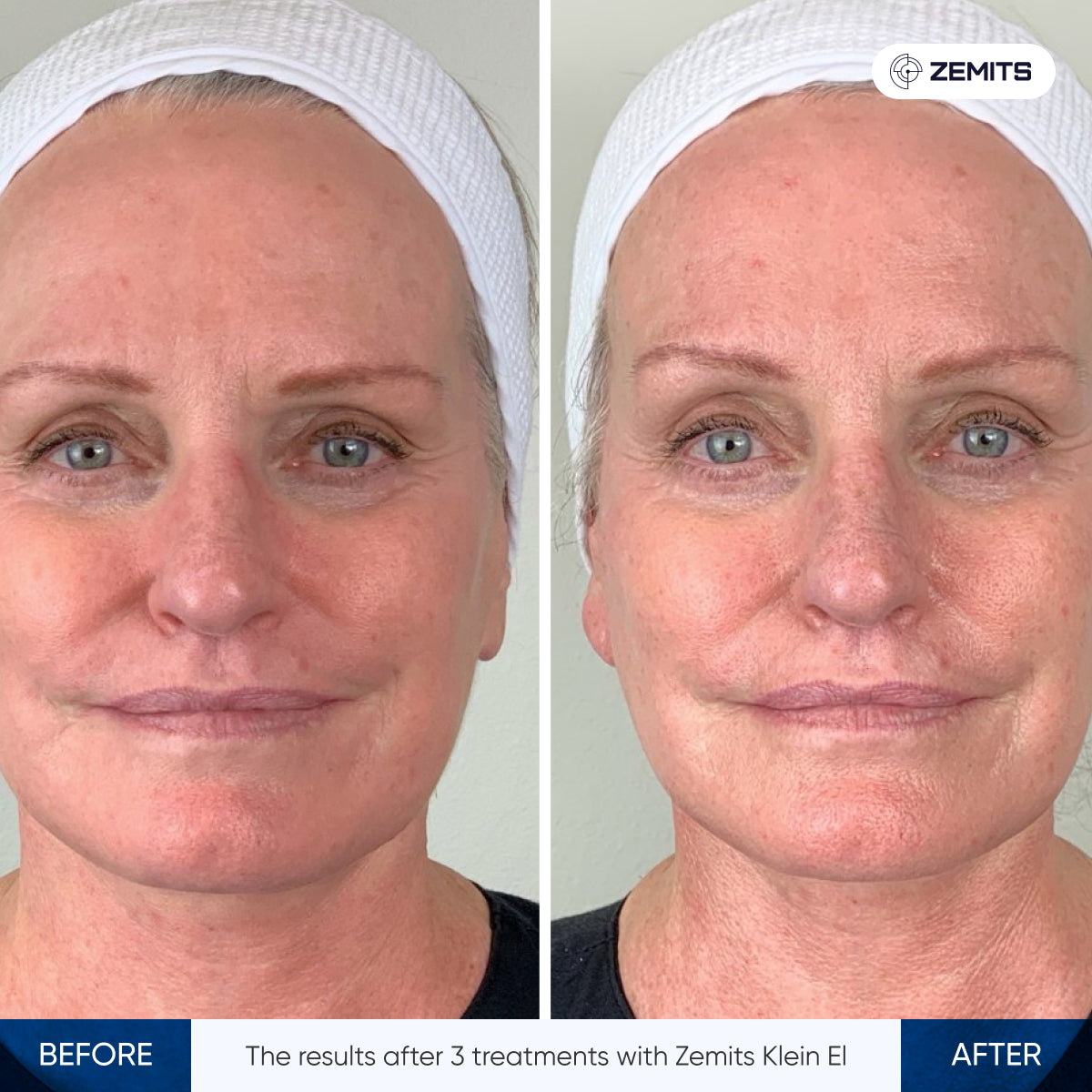 Before After Slide 3