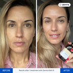 Before and after electroporation results Zemits Klein EL