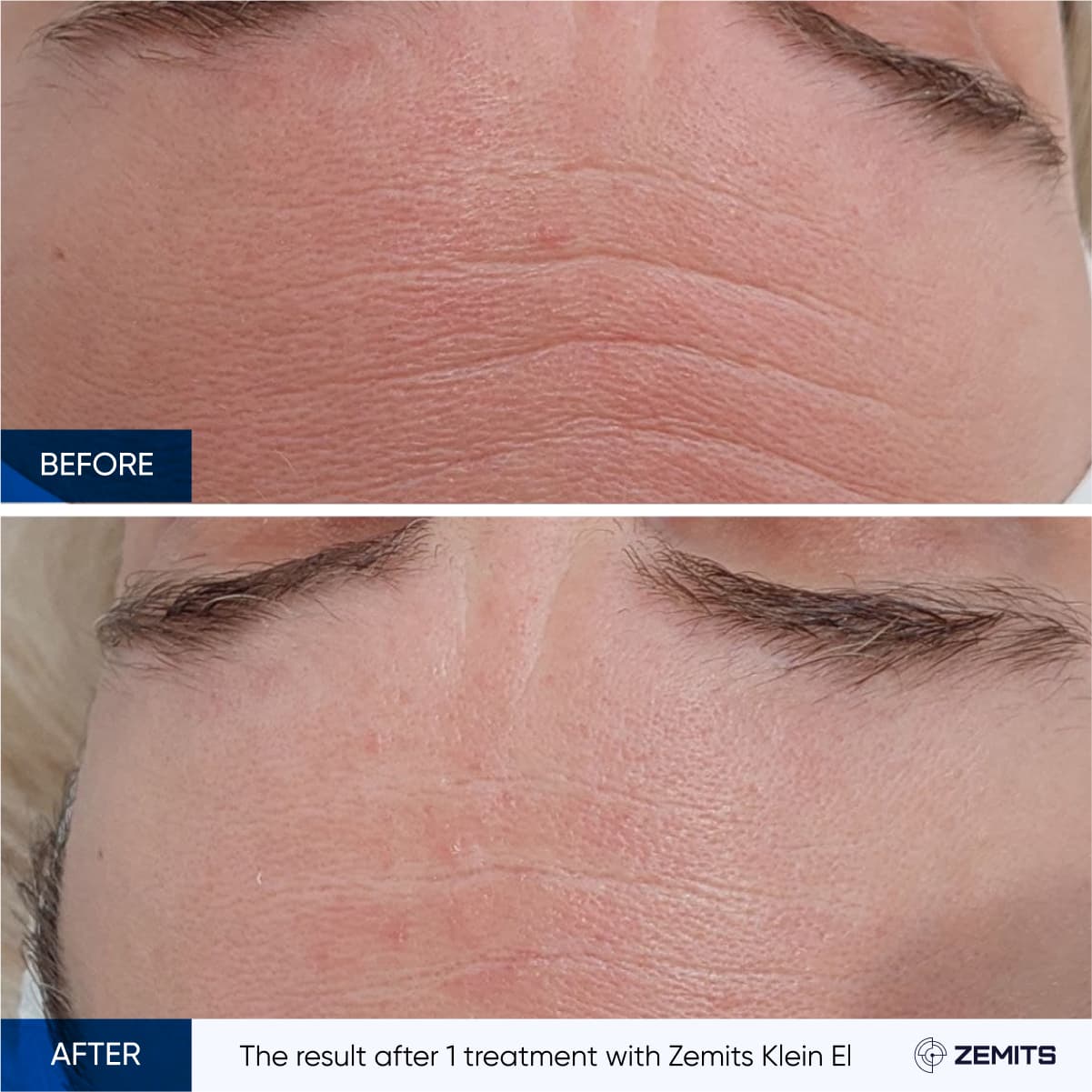 Before and after electroporation results Zemits Klein EL