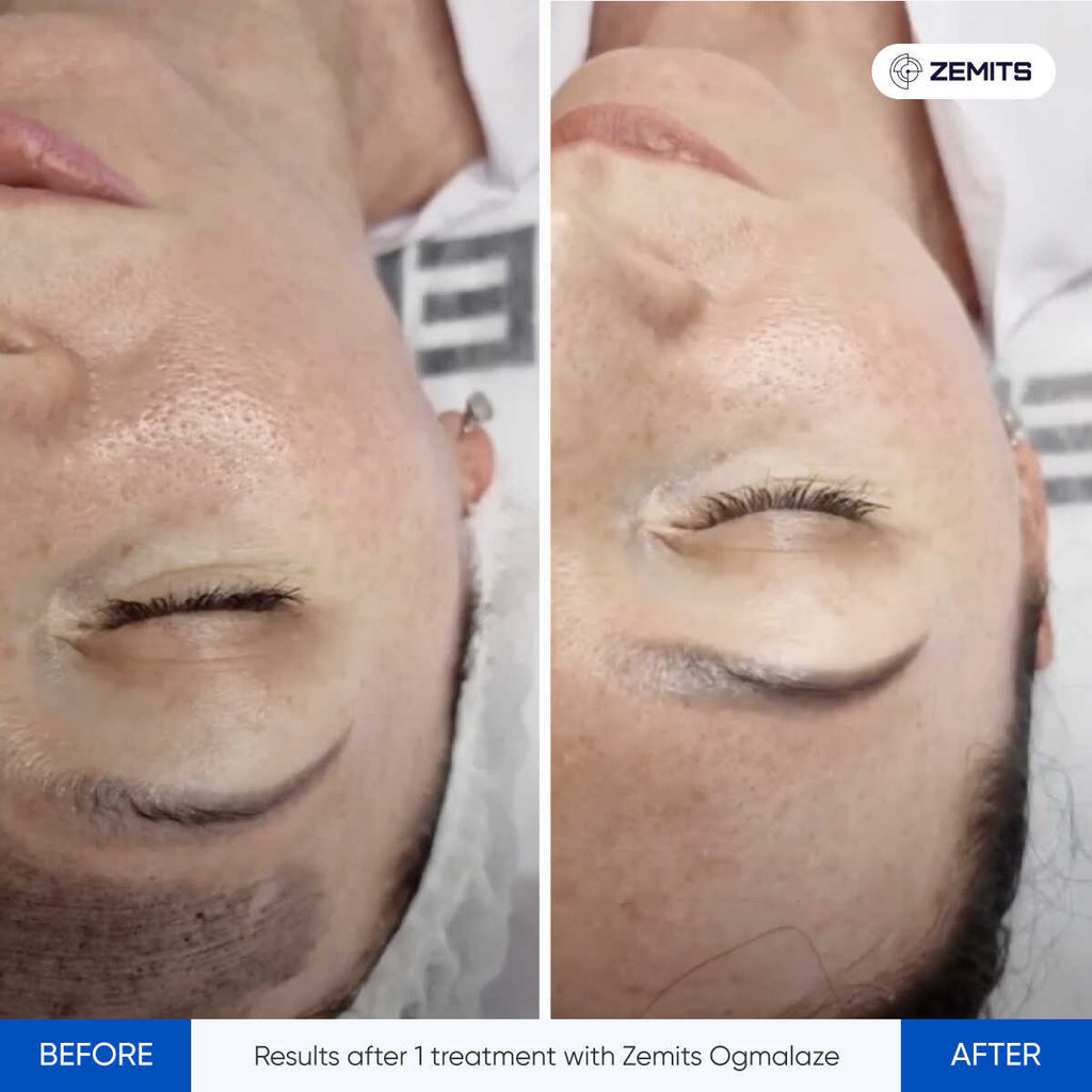 Before and after tattoo removal results Zemits OgmaLaze