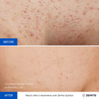 Before and after laser hair removal results Zemits Quidion