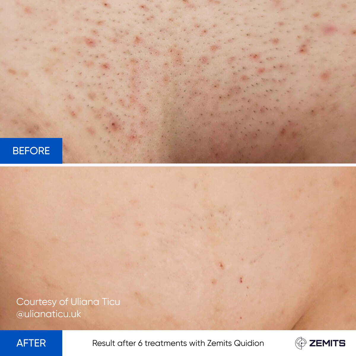 Before and after laser hair removal results Zemits Quidion
