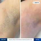 Before and after hair removal results Zemits Quidion Lite