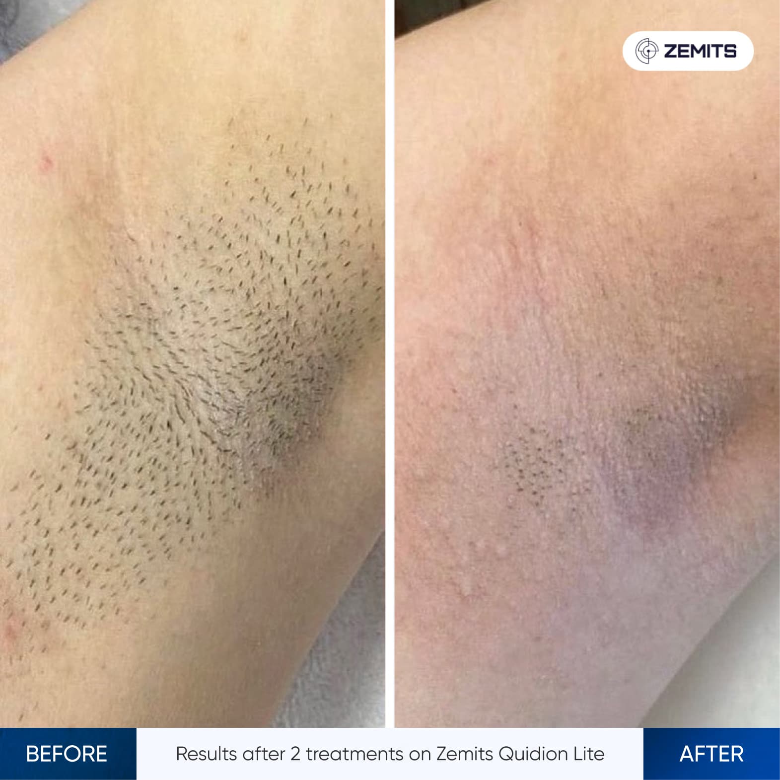 Before and after hair removal results Zemits Quidion Lite