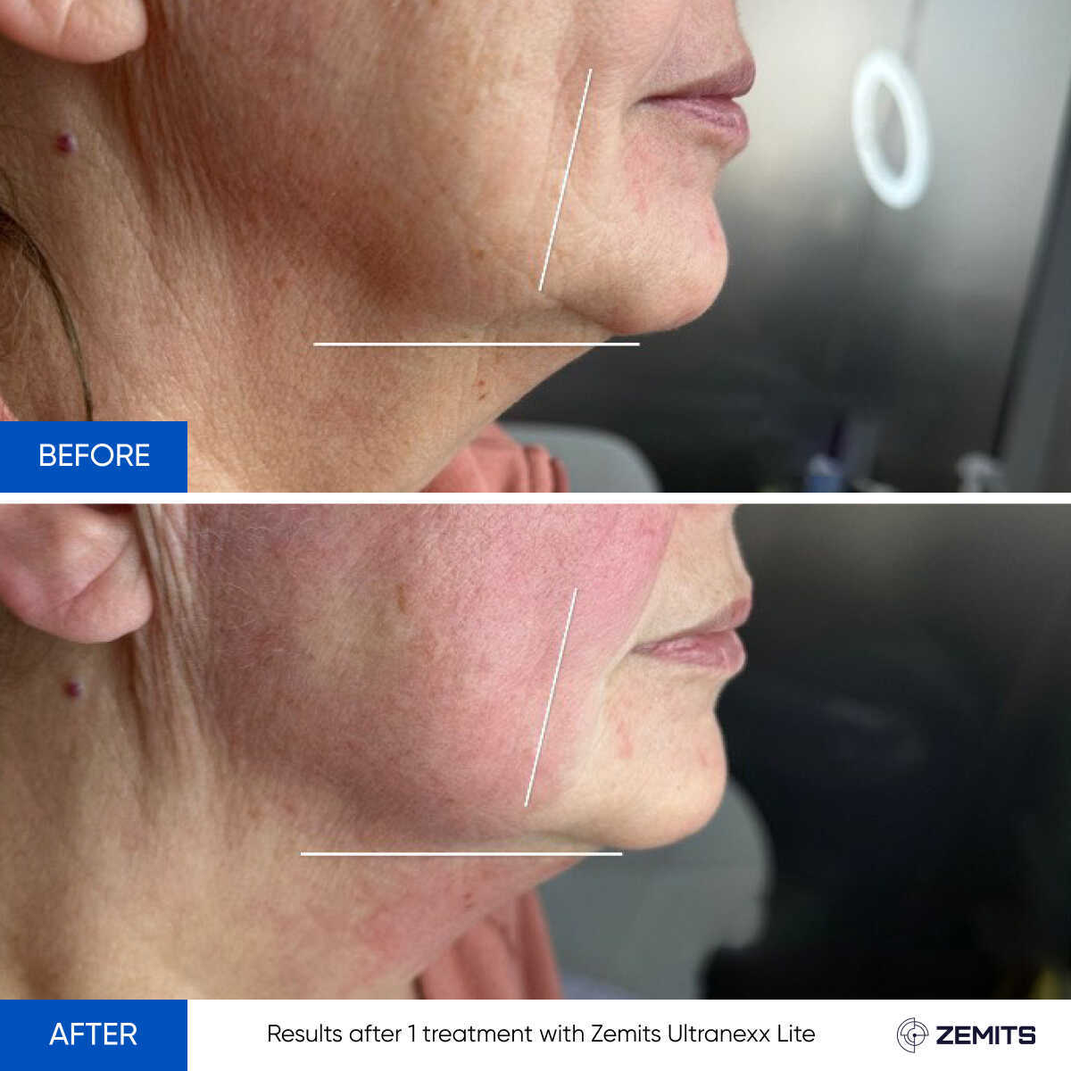 Before After Slide 4
